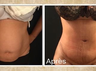 Abdominoplastie après grossesse gémellaire