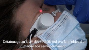 Détatouage au laser des sourcils qui ont fait l'objet d'un maquillage semi-permanent