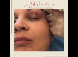 Blépharoplastie - Dr Catherine de Goursac