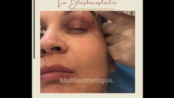 Blépharoplastie - Dr Catherine de Goursac