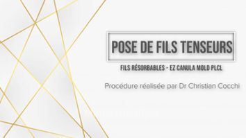 Pose de fils tenseurs - Dr Christian Cocchi