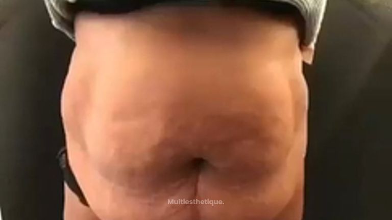 Abdominoplastie - Dr Paul Seknadje