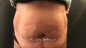 Abdominoplastie - Dr Paul Seknadje