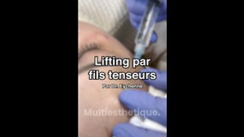 Lifting par fils tenseurs - Dr Catherine Eychenne - Esthetic Medicare Center