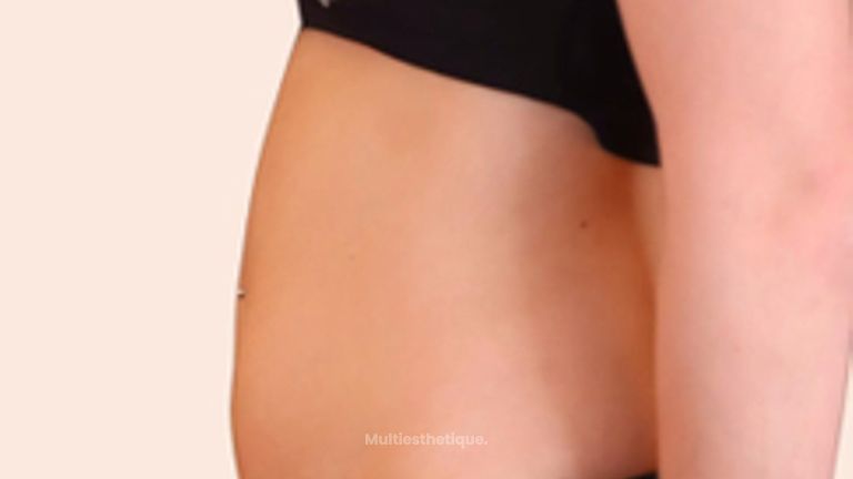 Liposuccion - Dr Maxime Cowen