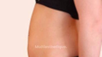 Liposuccion - Dr Maxime Cowen