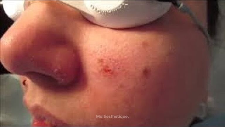 ABLATION GRAIN DE BEAUTÉ CENTRE LASER MURANO