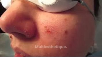 ABLATION GRAIN DE BEAUTÉ CENTRE LASER MURANO