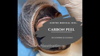 Carbon peel - Dr Catherine De Goursac