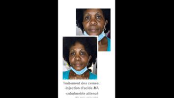 Traitement des cernes