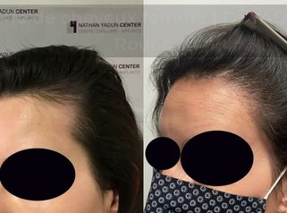 Résultat Greffe cheveux femme-Avant/Après-Implant capillaire femme