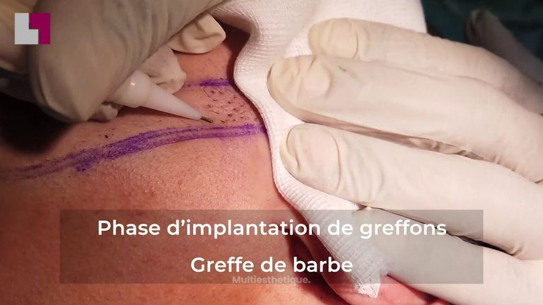 GREFFE DE BARBE- LA TECHNIQUE D'IMPLANTATION DE GREFFONS