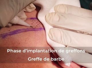 GREFFE DE BARBE- LA TECHNIQUE D'IMPLANTATION DE GREFFONS