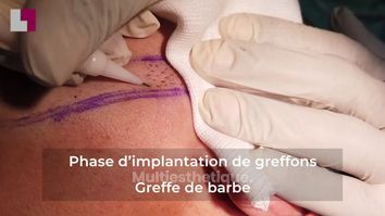 GREFFE DE BARBE- LA TECHNIQUE D'IMPLANTATION DE GREFFONS