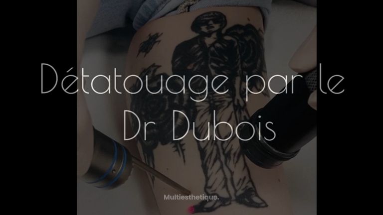 Détatouage par le Dr Dubois 