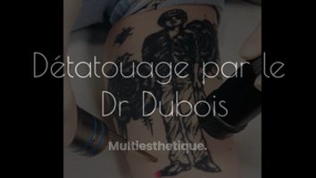 Détatouage par le Dr Dubois 