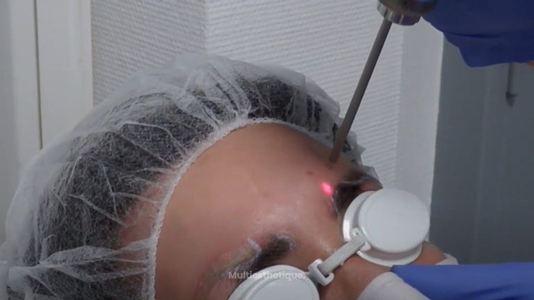 Détatouage laser des sourcils, sans douleur, technique simple et rapide avec une machine performante