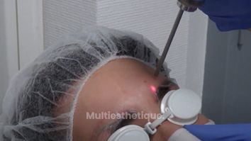 Détatouage laser des sourcils, sans douleur, technique simple et rapide avec une machine performante