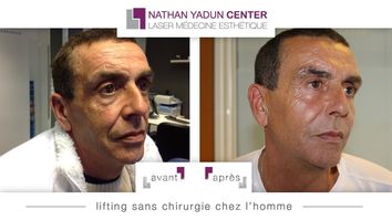 Lifting médical Chez l'Homme par injection acide hayluronique, Botox et Radiesse 