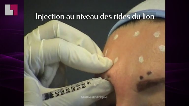 Injection Botox-Lissage des rides d'expression- front-lèvre-rides