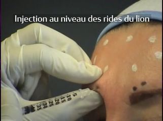 Injection Botox-Lissage des rides d'expression- front-lèvre-rides
