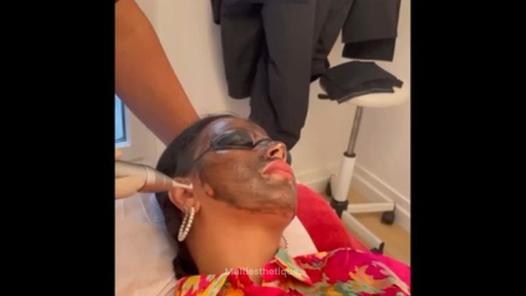 carbon laser peel - Dr Pascal Didi