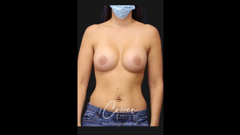 Augmentation mammaire - Dr Maxime Cowen