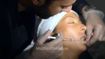 Injection acide hyaluronique Levres - Dr Michael Atlan