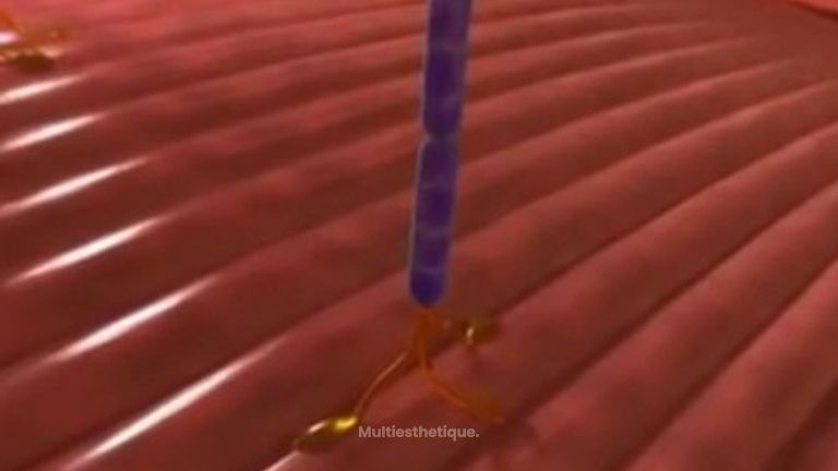 Pourquoi injecter le Botox dans le muscle ? 
