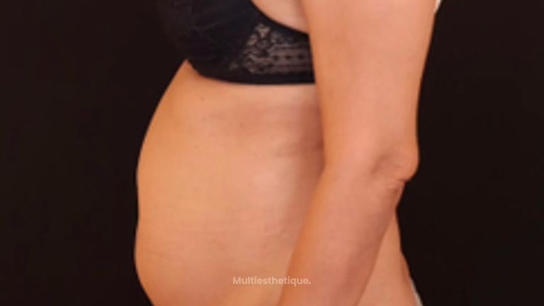 Abdominoplastie - Dr Maxime Cowen