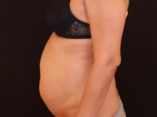 Abdominoplastie - Dr Maxime Cowen