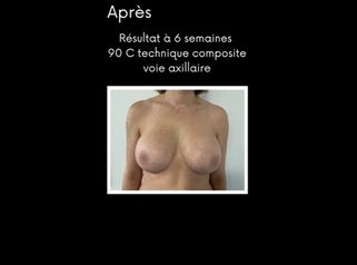 Augmentation mammaire - Dr Paul Seknadje