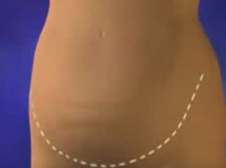 Comment se déroule une abdominoplastie ? 