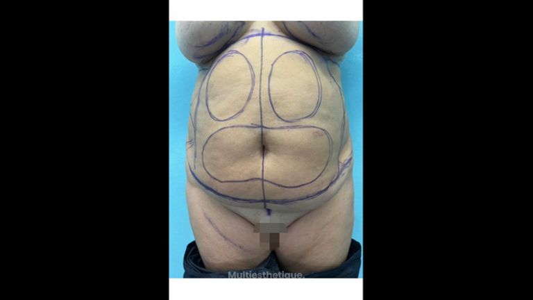 Lipoabdominoplastie - Dr Behzad Badie Modiri