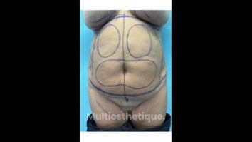 Lipoabdominoplastie - Dr Behzad Badie Modiri