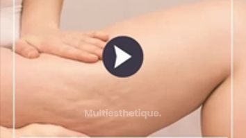 La cellulite - Dr Catherine de Goursac