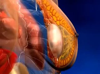Différents types d'implants mammaires