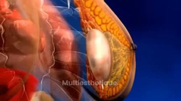 Différents types d'implants mammaires