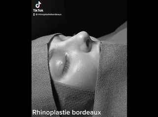 Rhinoplastie - Dr Pierre-Manuel Renard