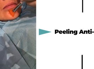 Peeling anti-acné - Dr Catherine De Goursac