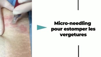 Microneedling - Dr Catherine de Goursac