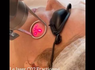Laser CO2 fractionné - Dr Pascal Didi