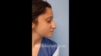 Rhinoplastie - Dr Mohamed Derder