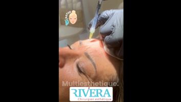 Botox - Dr Juan Carlos Rivera