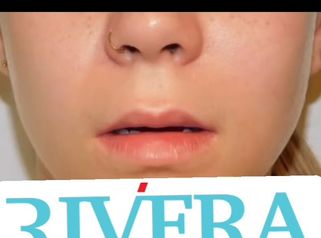 Augmentation des lèvres - Dr Juan Carlos Rivera