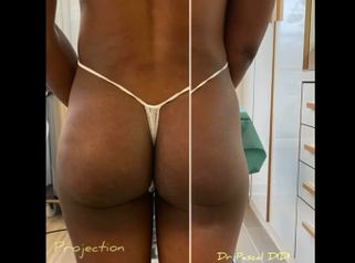 Galber les fesses par injection d’acide Hyaluronique - Dr. Pascal Didi