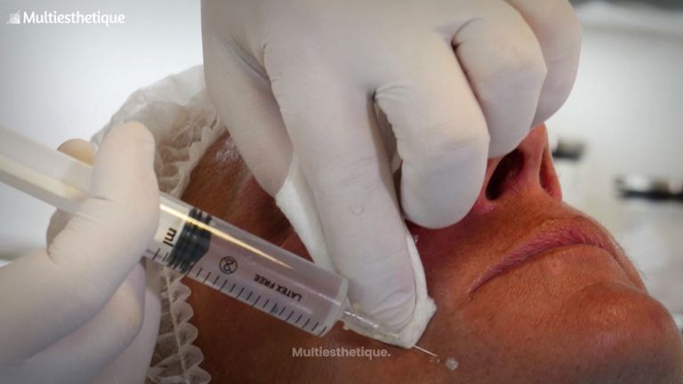 Les techniques de remaillage