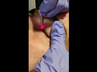 Blépharoplastie - Dr Marie Levisse - méDiKal esthétique
