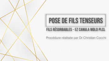 Pose de fils tenseurs - Dr Christian Cocchi