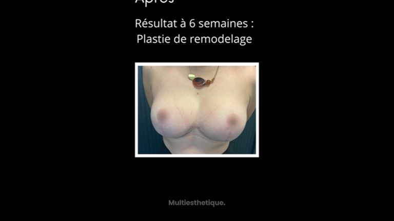 Réduction mammaire - Dr Paul Seknadje